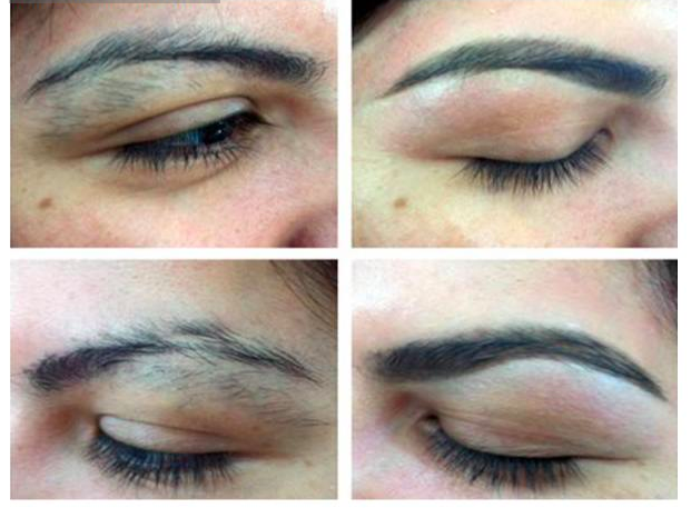 Eyebrow laser hair removal