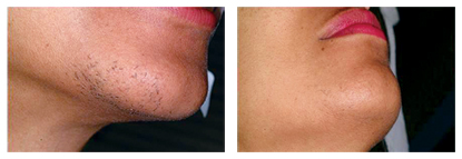Laser-Hair-Removal-Female-Face