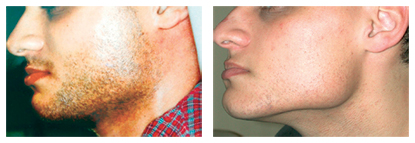 Laser-Hair-Removal-Male-Face2