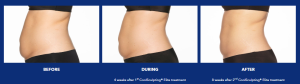 CoolSculpting in The Woodlands, TX