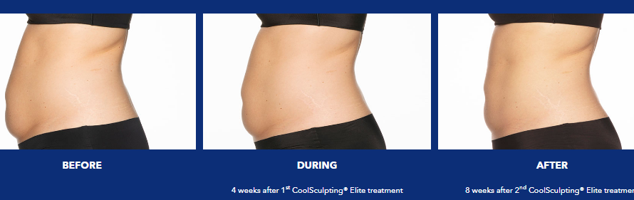 CoolSculpting in The Woodlands, TX